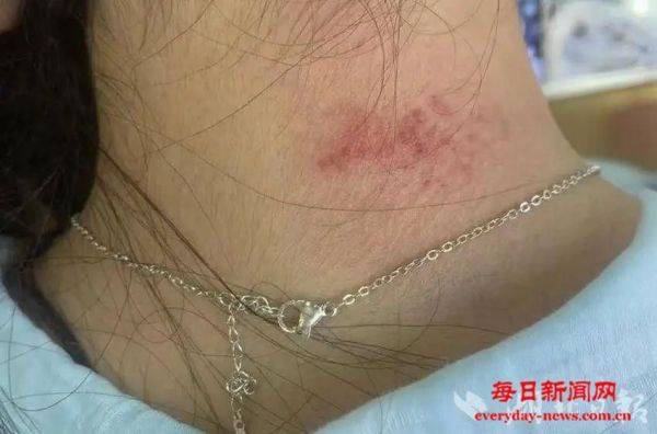 重金属超标！女子戴项链引发“首饰病” 医